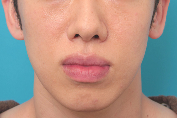 唇を薄く（口唇縮小術）,下唇を薄くした症例写真,Before,ba_usuku016_b01.jpg