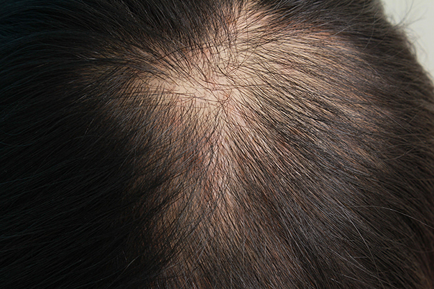 AGA治療（高須式メディカル育毛プログラム）,HARG治療（女性の薄毛治療）の症例写真,治療前,mainpic_aga_josei002a.jpg