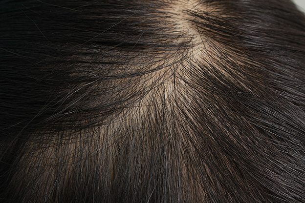 AGA治療（高須式メディカル育毛プログラム）,HARG治療（女性の薄毛治療）の症例写真,1ヶ月後,mainpic_aga_josei002b.jpg