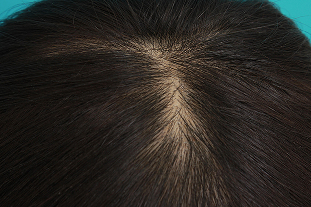 AGA治療（高須式メディカル育毛プログラム）,HARG治療（女性の薄毛治療）の症例写真,2ヶ月後,mainpic_aga_josei002c.jpg