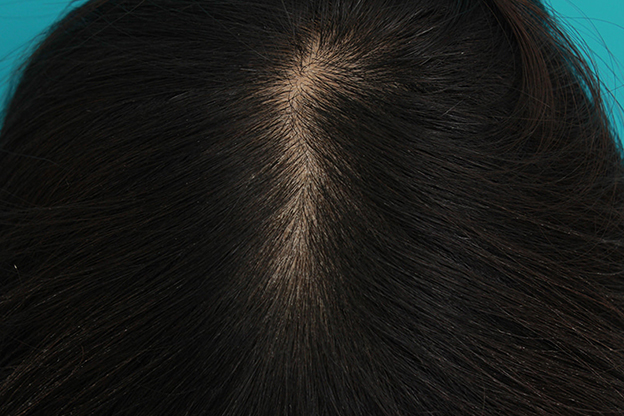 AGA治療（高須式メディカル育毛プログラム）,HARG治療（女性の薄毛治療）の症例写真,4ヶ月後,mainpic_aga_josei002d.jpg