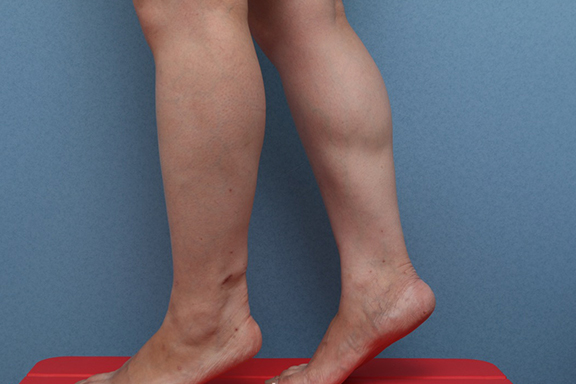 ボツリヌストキシン注射（ふくらはぎ・足やせ・美脚）,ふくらはぎボツリヌストキシン注射の症例写真,Before,ba_leg012_b02.jpg