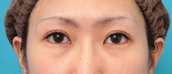 垂れ目（パンダ目）形成（グラマラスライン／下眼瞼下制術）,上まぶたたるみとり・目尻切開・垂れ目形成の症例写真,After（6ヶ月後）,ba_tarumi015_b01.jpg