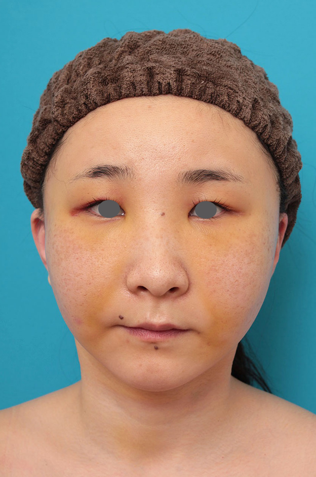 症例写真,ミニフェイスリフト（頬のたるみ取り）・脂肪吸引（頬、あご）の症例写真,1週間後,mainpic_minilift009b.jpg