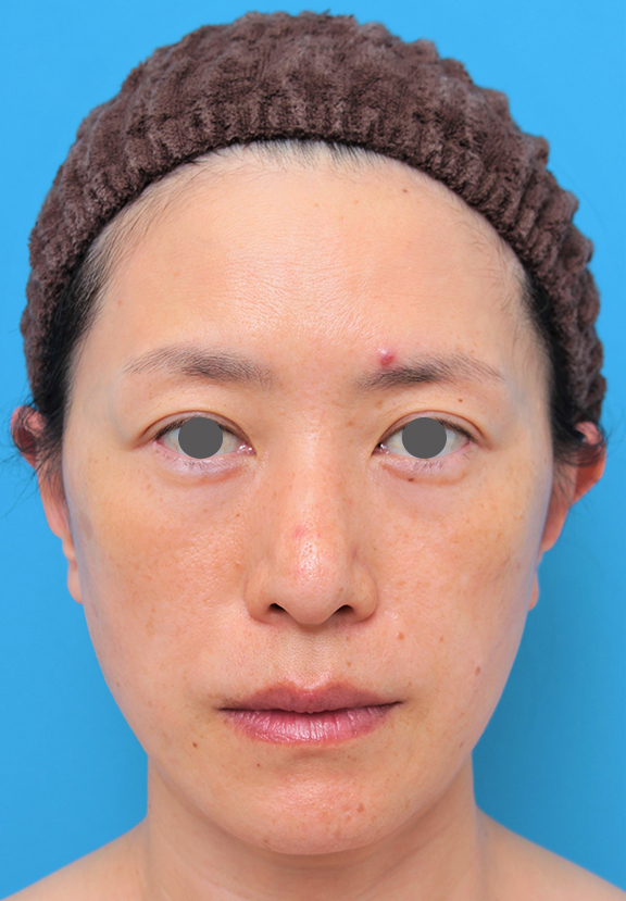 40代後半女性のミディアムフェイスリフトの症例写真,After（6ヶ月後）,ba_mediumlift011_a01.jpg