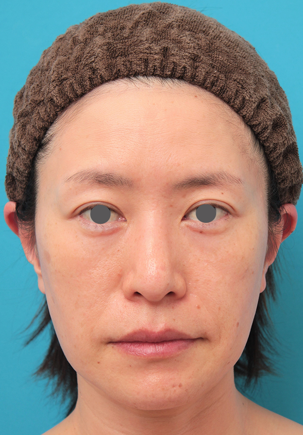 ミディアムフェイスリフト,40代後半女性のミディアムフェイスリフトの症例写真,手術前,mainpic_mediumlift011a.jpg