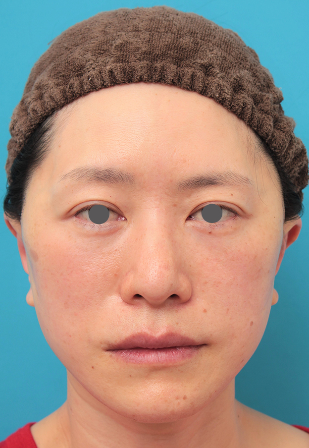 ミディアムフェイスリフト,40代後半女性のミディアムフェイスリフトの症例写真,手術直後,mainpic_mediumlift011b.jpg