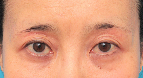 くぼみ目修正（ヒアルロン酸注射）,目の上の窪みにヒアルロン酸注射した50代女性の症例写真,Before,ba_kubomi009_b01.jpg