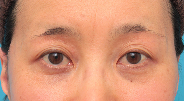 注射式シワ取り 長期持続型ヒアルロン酸注入,目の上の窪みにヒアルロン酸注射した50代女性の症例写真,1週間後,mainpic_kubomi009b.jpg