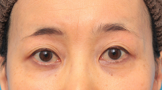 注射式シワ取り 長期持続型ヒアルロン酸注入,目の上の窪みにヒアルロン酸注射した50代女性の症例写真,6ヶ月後,mainpic_kubomi009c.jpg
