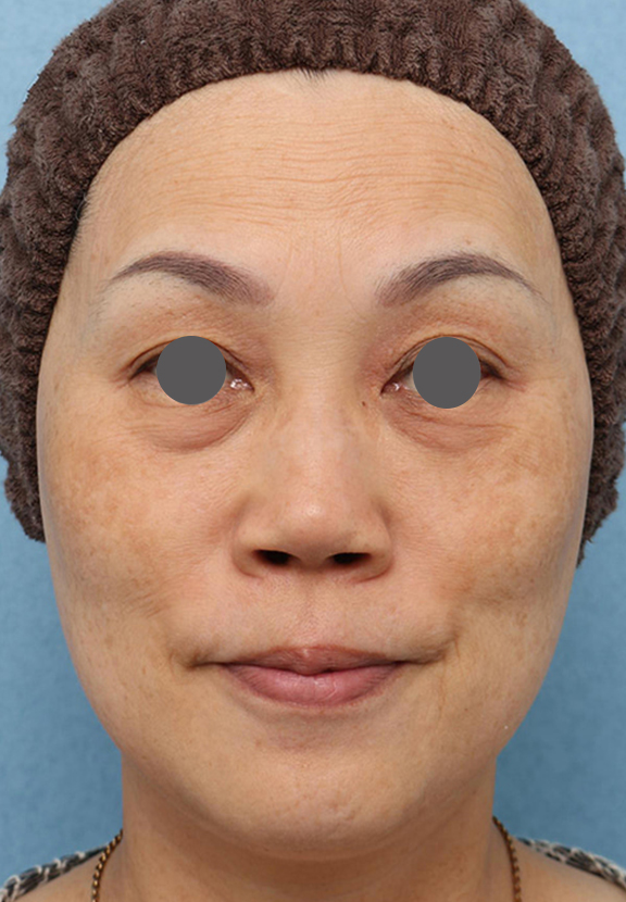 目の下のクマ治療,目の下の膨らみの段差改善の症例写真,After（2ヶ月後）,ba_tarumi_under002_b01.jpg