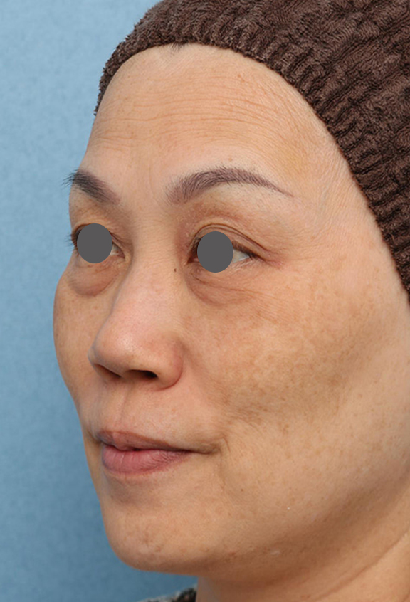 目の下のクマ治療,目の下の膨らみの段差改善の症例写真,After（2ヶ月後）,ba_tarumi_under002_b02.jpg