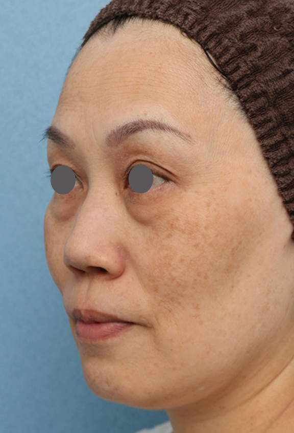 目の下のクマ治療,目の下の膨らみの段差改善の症例写真,Before,ba_tarumi_under002_b02.jpg