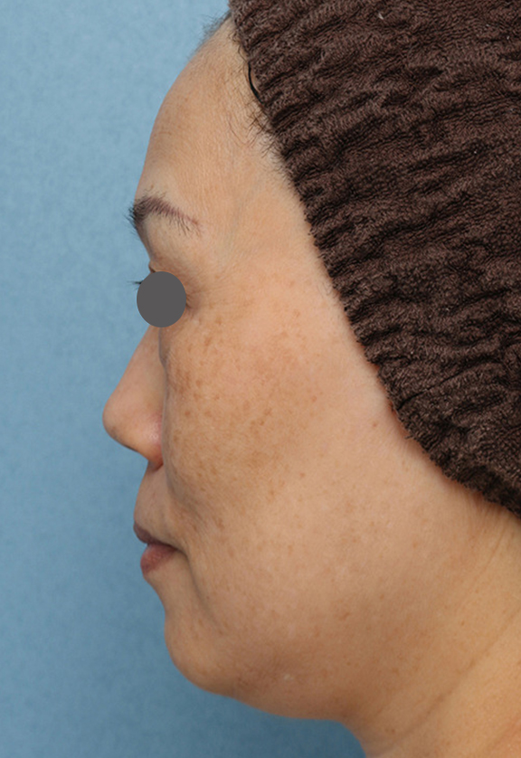 目の下のクマ治療,目の下の膨らみの段差改善の症例写真,Before,ba_tarumi_under002_b03.jpg