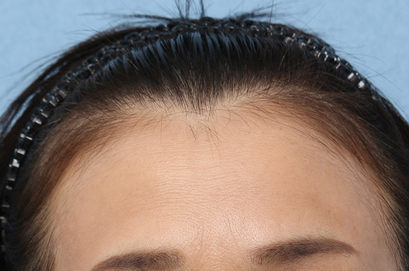 AGA治療（高須式メディカル育毛プログラム）,女性の薄毛治療,PRP育毛治療の症例写真,After（2ヶ月後）,ba_aga_josei003_a01.jpg