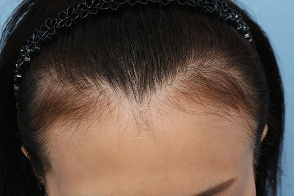 女性の薄毛治療,PRP育毛治療の症例写真,After（2ヶ月後）,ba_aga_josei003_b02.jpg