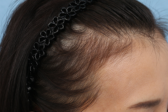 女性の薄毛治療,PRP育毛治療の症例写真,After（2ヶ月後）,ba_aga_josei003_b03.jpg