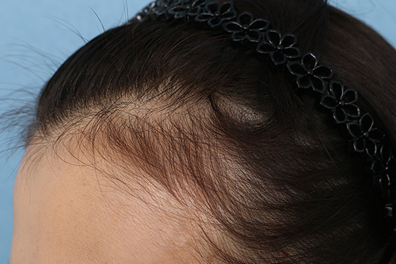 女性の薄毛治療,PRP育毛治療の症例写真,After（2ヶ月後）,ba_aga_josei003_b04.jpg