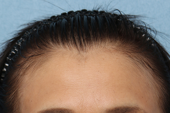女性の薄毛治療,PRP育毛治療の症例写真,Before,ba_aga_josei003_b01.jpg