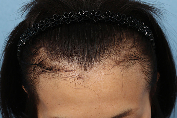 AGA治療（高須式メディカル育毛プログラム）,PRP育毛治療の症例写真,Before,ba_aga_josei003_b02.jpg