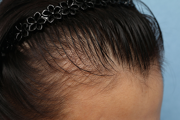 女性の薄毛治療,PRP育毛治療の症例写真,Before,ba_aga_josei003_b03.jpg