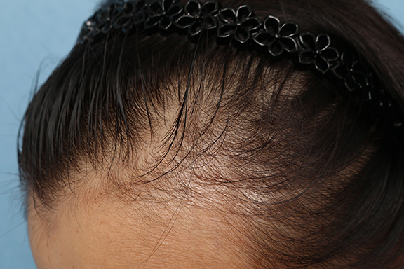 女性の薄毛治療,PRP育毛治療の症例写真,Before,ba_aga_josei003_b04.jpg
