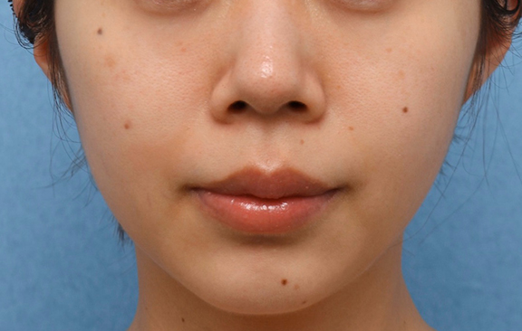 ウルセラシステム,ウルセラシステムの症例 頬の肉づき、たるみが気になる30代女性,After（2ヶ月後）,ba_ulthera035_a01.jpg