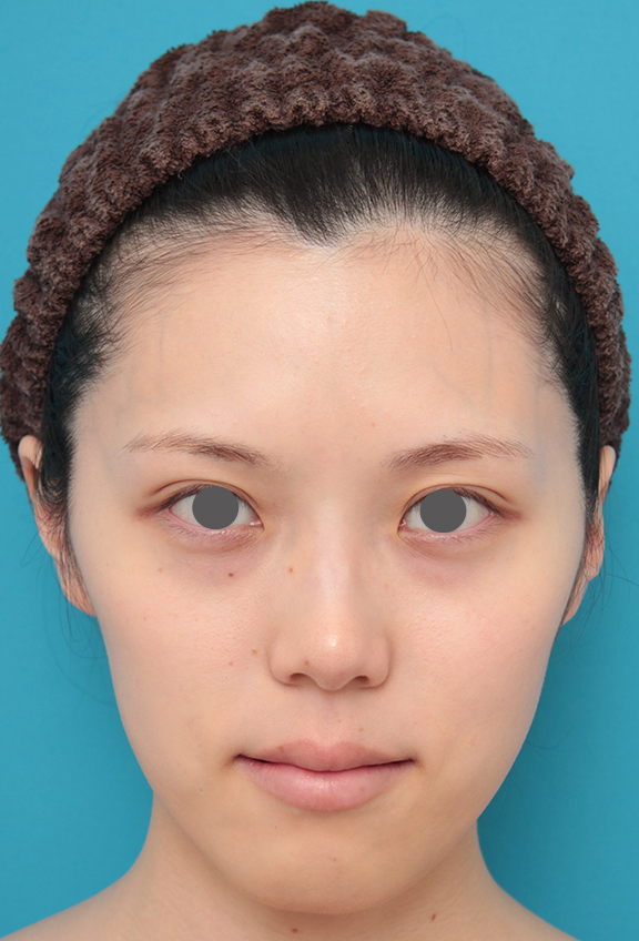 ヒアルロン酸チークヒアル（ヒアルロン酸で頬やこめかみをふっくら）,チークヒアルと顎のヒアルロン酸注射を同時に行った20代女性の症例写真,Before,ba_cheek002_b01.jpg