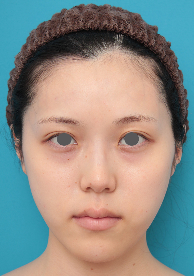 ヒアルロン酸チークヒアル（ヒアルロン酸で頬やこめかみをふっくら）,チークヒアルと顎のヒアルロン酸注射を同時に行った20代女性の症例写真,注射直後,mainpic_cheek002b.jpg