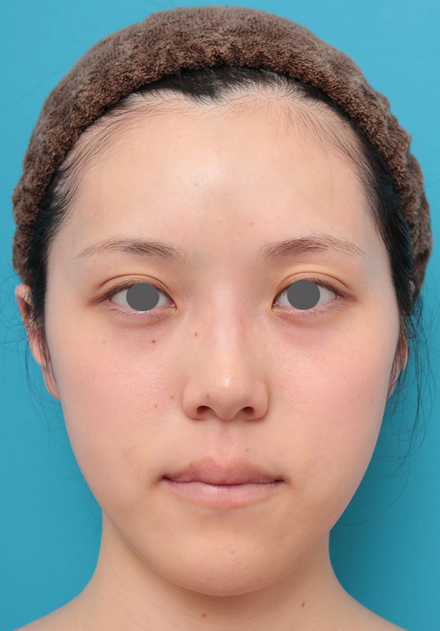 ヒアルロン酸チークヒアル（ヒアルロン酸で頬やこめかみをふっくら）,チークヒアルと顎のヒアルロン酸注射を同時に行った20代女性の症例写真,10日後,mainpic_cheek002c.jpg