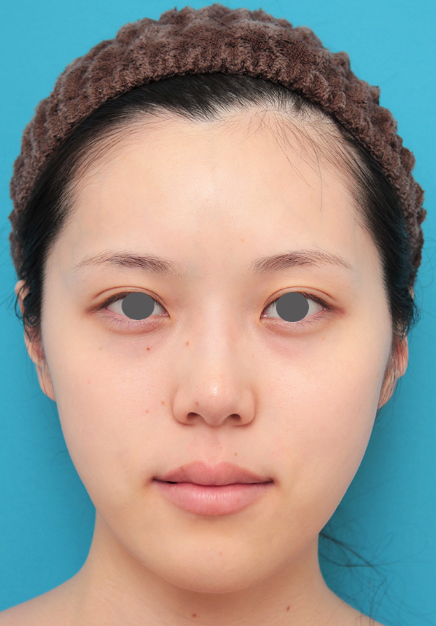 ヒアルロン酸チークヒアル（ヒアルロン酸で頬やこめかみをふっくら）,チークヒアルと顎のヒアルロン酸注射を同時に行った20代女性の症例写真,1ヶ月後,mainpic_cheek002d.jpg
