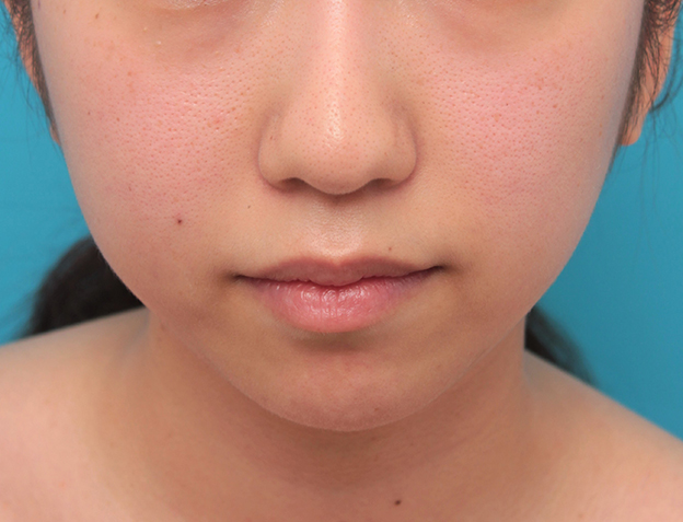あごのシリコンプロテーゼ抜き（除去）,顎のシリコンプロテーゼの入れ替え手術をして更に顎を出した症例写真,手術前,mainpic_ago021a.jpg