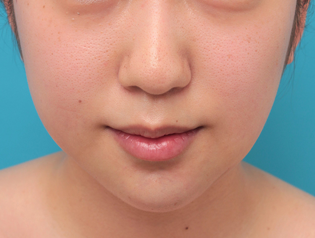 あご形成（シリコンプロテーゼ）,顎のシリコンプロテーゼの入れ替え手術をして更に顎を出した症例写真,手術直後,mainpic_ago021b.jpg