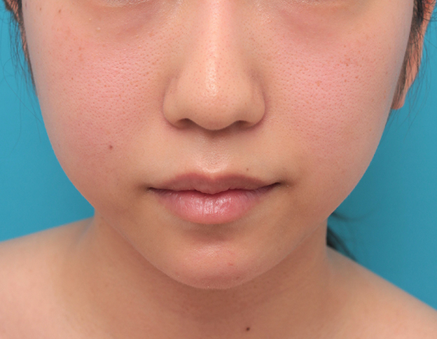 あご形成（シリコンプロテーゼ）,顎のシリコンプロテーゼの入れ替え手術をして更に顎を出した症例写真,6ヶ月後,mainpic_ago021d.jpg