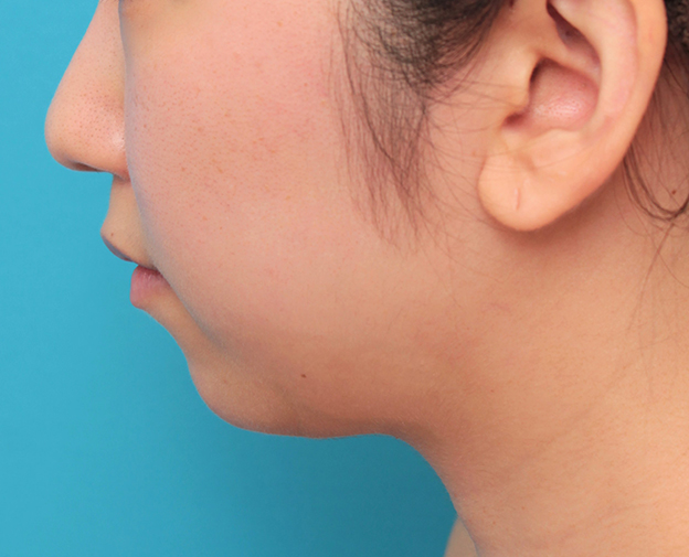 あご形成（シリコンプロテーゼ）,顎のシリコンプロテーゼの入れ替え手術をして更に顎を出した症例写真,手術前,mainpic_ago021e.jpg