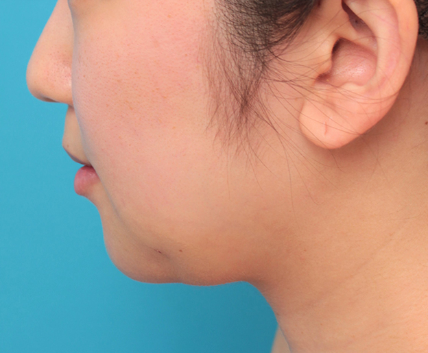 あごのシリコンプロテーゼ抜き（除去）,顎のシリコンプロテーゼの入れ替え手術をして更に顎を出した症例写真,手術直後,mainpic_ago021f.jpg