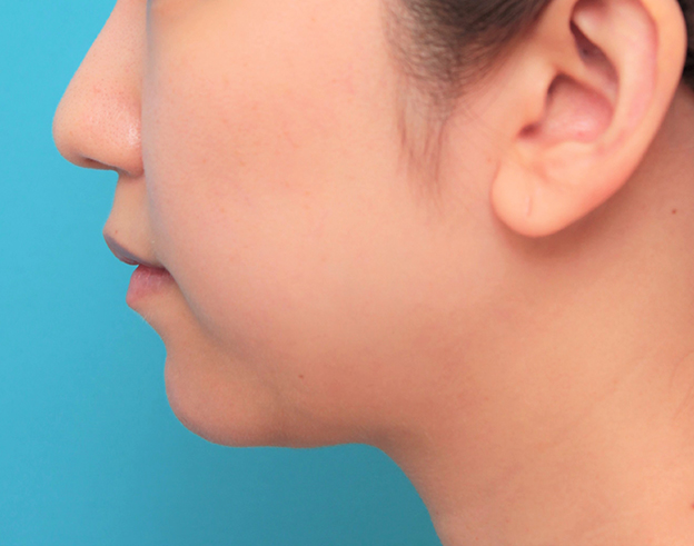 あご形成（シリコンプロテーゼ）,顎のシリコンプロテーゼの入れ替え手術をして更に顎を出した症例写真,6ヶ月後,mainpic_ago021h.jpg