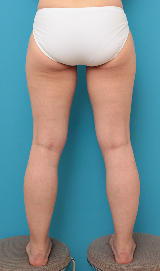 脂肪吸引,太もも全体とふくらはぎの脂肪吸引をした40代女性の症例写真,手術前,mainpic_shibokyuin043g.jpg