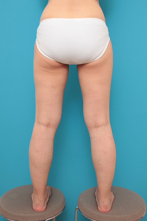 症例写真,太もも全体とふくらはぎの脂肪吸引をした40代女性の症例写真,4ヶ月後,mainpic_shibokyuin043k.jpg
