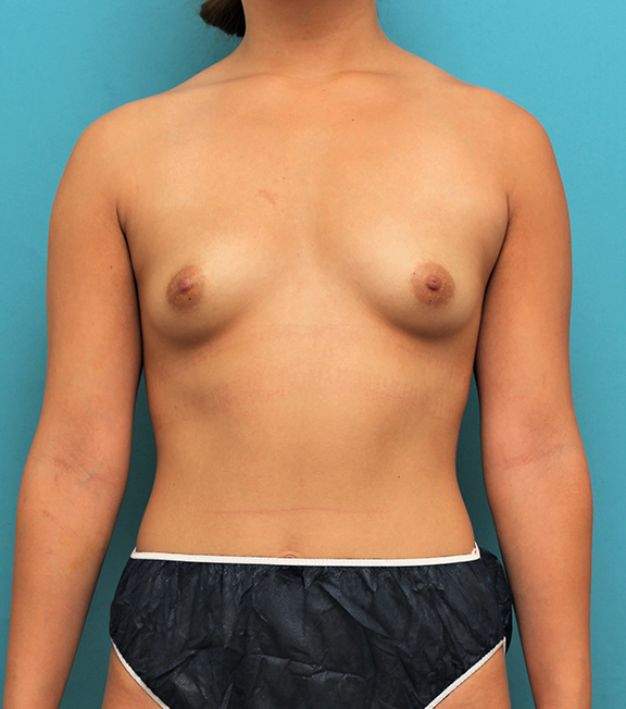 脂肪吸引,20代女性のお尻、太ももから脂肪吸引してバストに脂肪注入した症例写真,Before,ba_inject026_b01.jpg