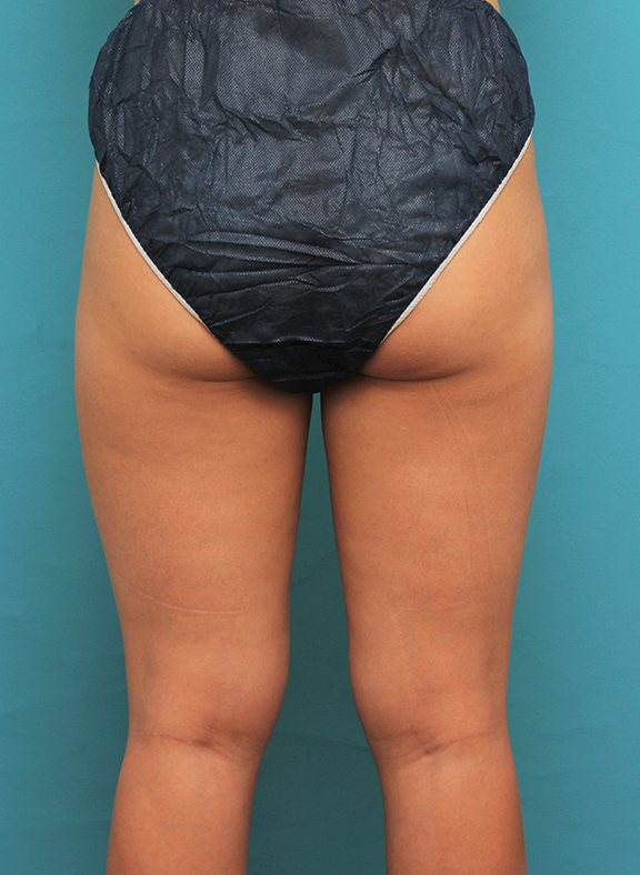 脂肪吸引,20代女性のお尻、太ももから脂肪吸引してバストに脂肪注入した症例写真,Before,ba_inject026_b04.jpg