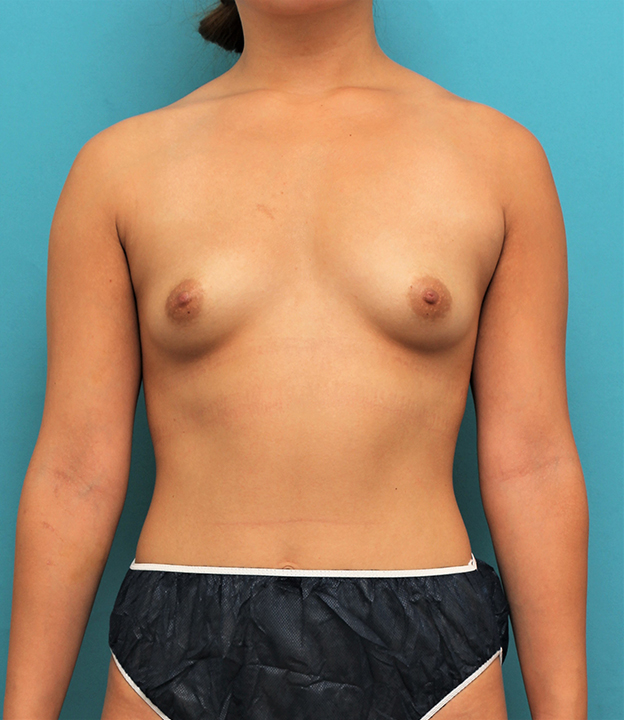 脂肪吸引,20代女性のお尻、太ももから脂肪吸引してバストに脂肪注入した症例写真,手術前,mainpic_inject026a.jpg