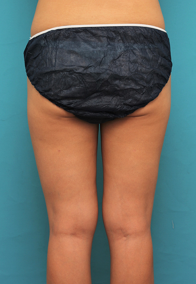 脂肪吸引,20代女性のお尻、太ももから脂肪吸引してバストに脂肪注入した症例写真,4ヶ月後,mainpic_inject026j.jpg