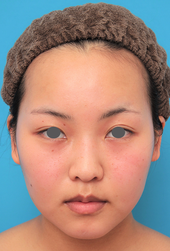 症例写真,顔専用脂肪溶解注射メソシェイプフェイスで小顔になった20代女性の症例写真,After（2回目注射後3週間）,ba_meso_face017_b01.jpg