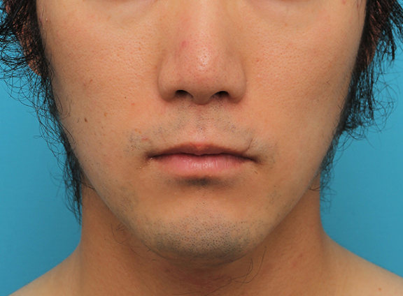 鼻の下を短く（上口唇短縮手術、上口唇リフト、リップリフト、人中短縮術）,リップリフト(人中短縮手術)を行った30代男性の症例写真,After（6ヶ月後）,ba_hanashita004_b01.jpg