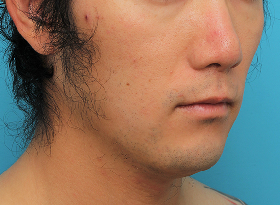 鼻の下を短く（上口唇短縮手術、上口唇リフト、リップリフト、人中短縮術）,リップリフト(人中短縮手術)を行った30代男性の症例写真,After（6ヶ月後）,ba_hanashita004_b02.jpg