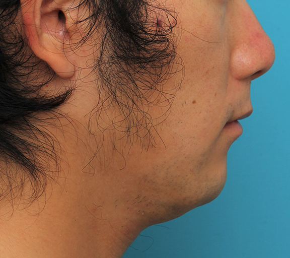 鼻の下を短く（上口唇短縮手術、上口唇リフト、リップリフト、人中短縮術）,リップリフト(人中短縮手術)を行った30代男性の症例写真,After（6ヶ月後）,ba_hanashita004_b03.jpg