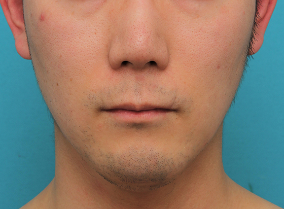 鼻の下を短く（上口唇短縮手術、上口唇リフト、リップリフト、人中短縮術）,リップリフト(人中短縮手術)を行った30代男性の症例写真,Before,ba_hanashita004_b01.jpg