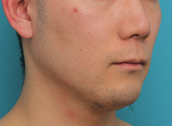 鼻の下を短く（上口唇短縮手術、上口唇リフト、リップリフト、人中短縮術）,リップリフト(人中短縮手術)を行った30代男性の症例写真,Before,ba_hanashita004_b02.jpg