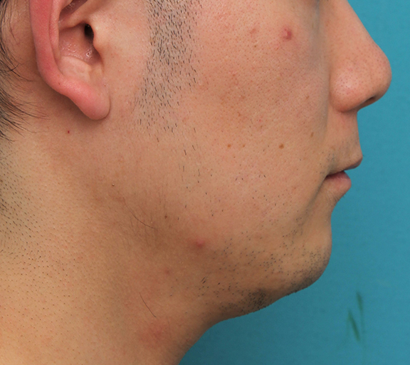鼻の下を短く（上口唇短縮手術、上口唇リフト、リップリフト、人中短縮術）,リップリフト(人中短縮手術)を行った30代男性の症例写真,Before,ba_hanashita004_b03.jpg